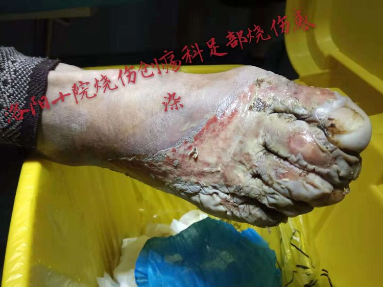 9170金沙集团_洛阳第十人民医院烧伤创疡科乐成拯救一名足烧伤患者