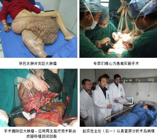 9170金沙集团_南通市三院接纳皮肤再生疗法为患者乐成切除重大肿瘤
