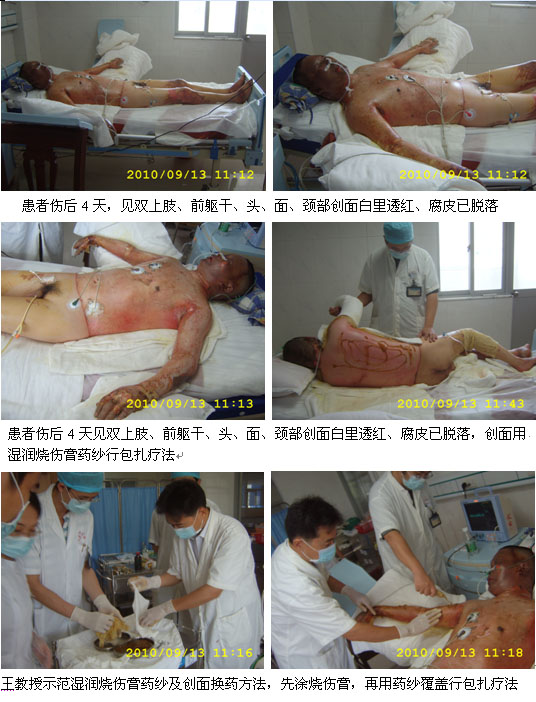 9170金沙集团_惠州市第一人民医院抢救大面积烧伤患者再外行艺显奇效