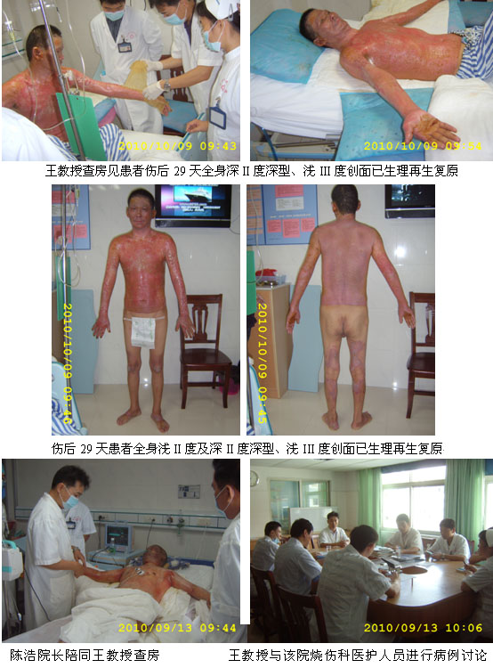 9170金沙集团_惠州市第一人民医院抢救大面积烧伤患者再外行艺显奇效