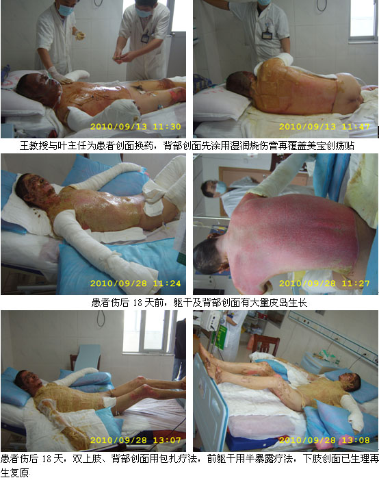 9170金沙集团_惠州市第一人民医院抢救大面积烧伤患者再外行艺显奇效