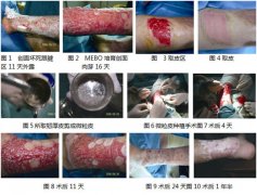 9170金沙集团_再生医疗手艺配合微粒皮培植修复皮肤慢性溃疡创面的临床剖析