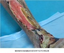 9170金沙集团_皮肤原位再生医疗手艺在舞阳县人民医院推广