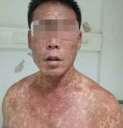 9170金沙集团_药疹——禁止忽视的皮疹