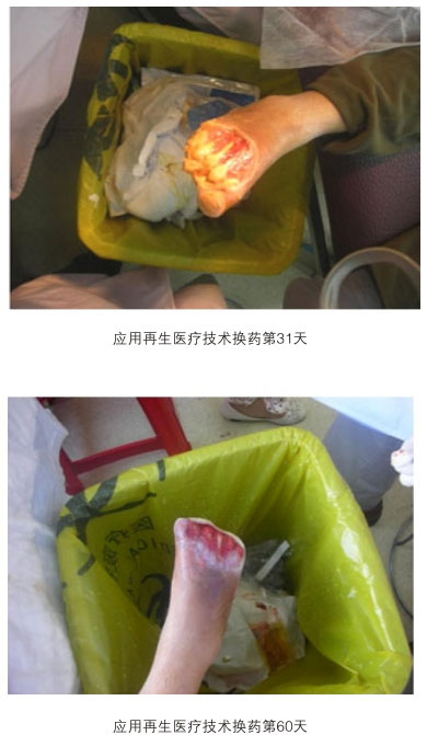 9170金沙集团_三、糖尿病及动脉闭塞肢体远端坏死溃疡再生愈合