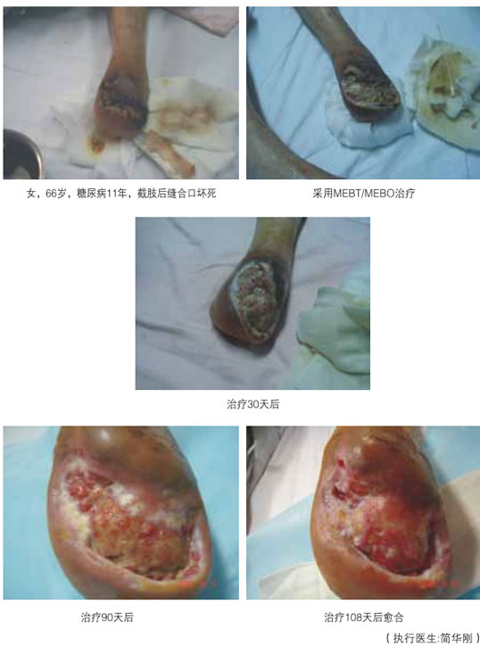 9170金沙集团_三、糖尿病及动脉闭塞肢体远端坏死溃疡再生愈合