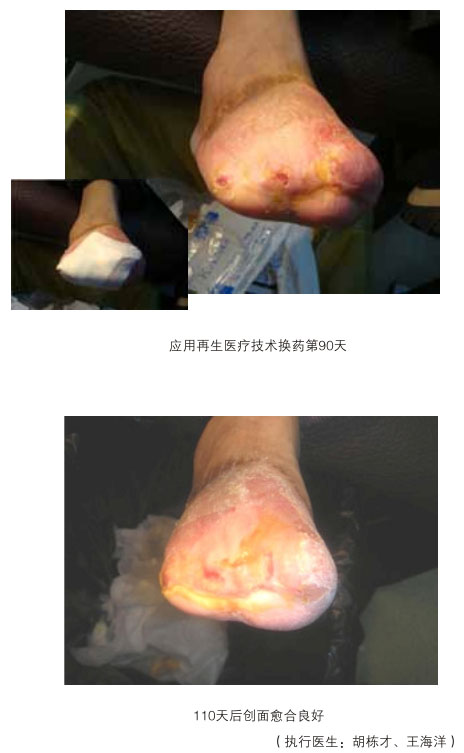 9170金沙集团_三、糖尿病及动脉闭塞肢体远端坏死溃疡再生愈合