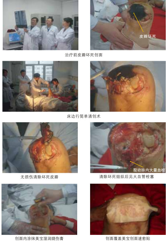 9170金沙集团_三、糖尿病及动脉闭塞肢体远端坏死溃疡再生愈合