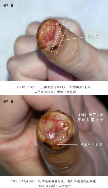 9170金沙集团_二、断指的再生回复