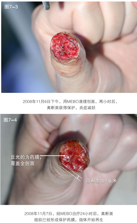 9170金沙集团_二、断指的再生回复