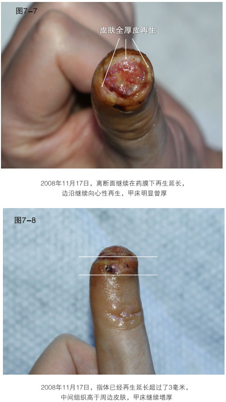 9170金沙集团_二、断指的再生回复