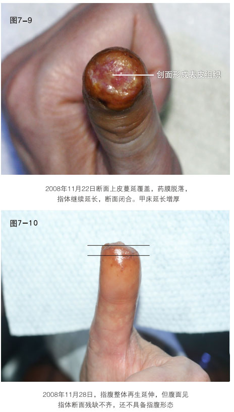 9170金沙集团_二、断指的再生回复