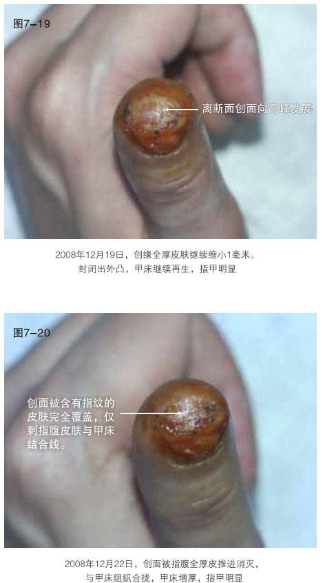 9170金沙集团_二、断指的再生回复