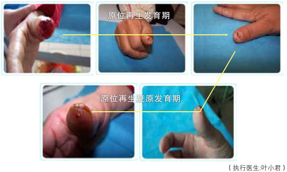 9170金沙集团_二、断指的再生回复