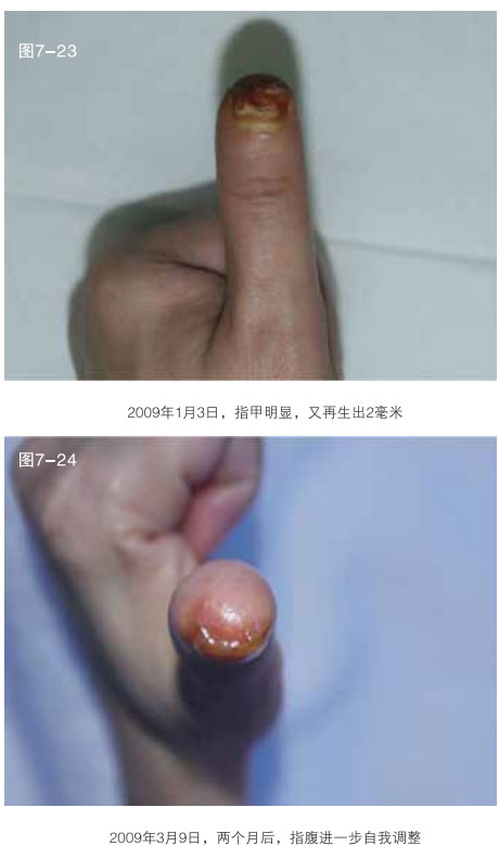 9170金沙集团_二、断指的再生回复