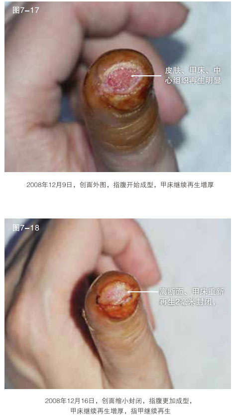 9170金沙集团_二、断指的再生回复