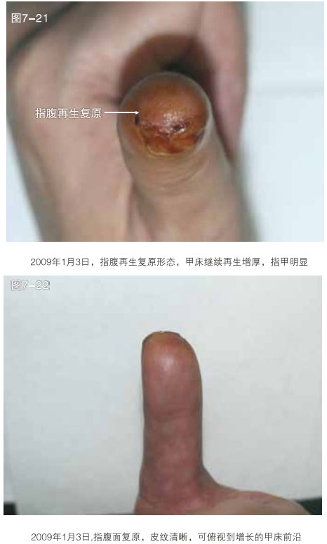9170金沙集团_二、断指的再生回复