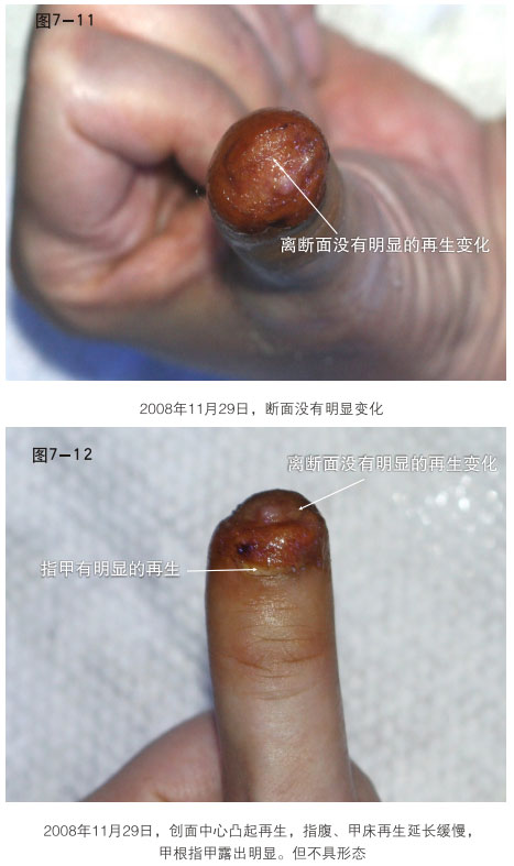 9170金沙集团_二、断指的再生回复