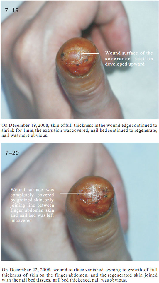 9170金沙集团_2 Regenerative restoration ofr severed fingers