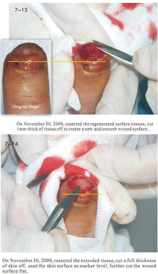 9170金沙集团_2 Regenerative restoration ofr severed fingers