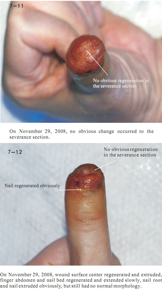 9170金沙集团_2 Regenerative restoration ofr severed fingers