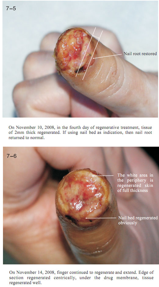 9170金沙集团_2 Regenerative restoration ofr severed fingers