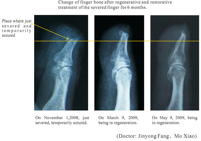 9170金沙集团_2 Regenerative restoration ofr severed fingers