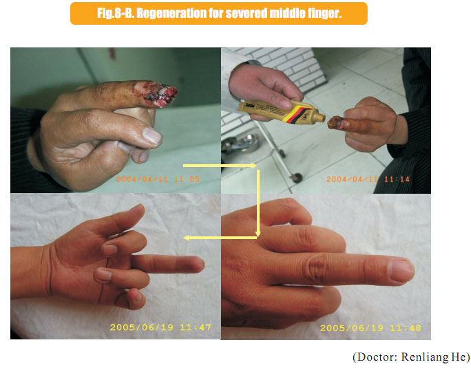 9170金沙集团_2 Regenerative restoration ofr severed fingers
