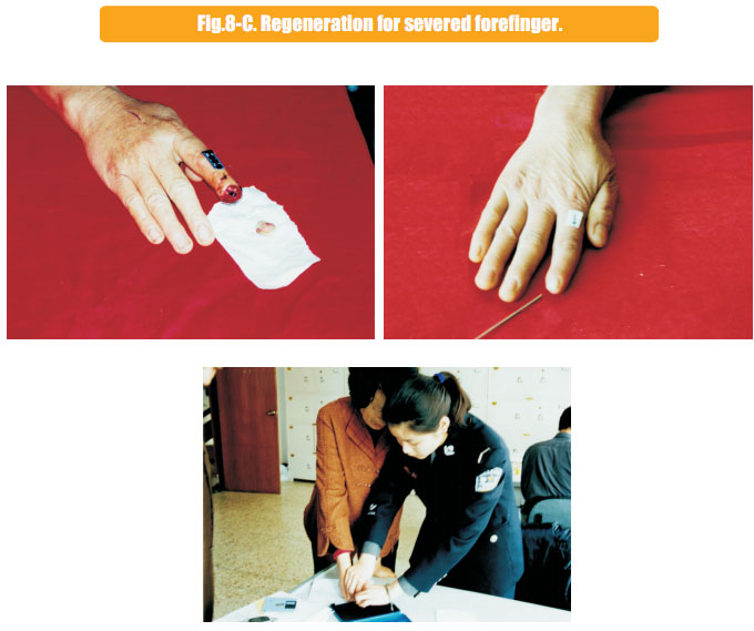 9170金沙集团_2 Regenerative restoration ofr severed fingers