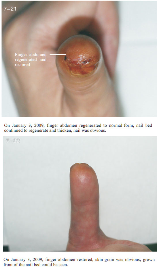 9170金沙集团_2 Regenerative restoration ofr severed fingers