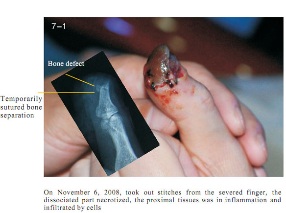 9170金沙集团_2 Regenerative restoration ofr severed fingers