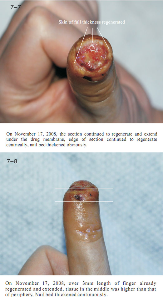 9170金沙集团_2 Regenerative restoration ofr severed fingers