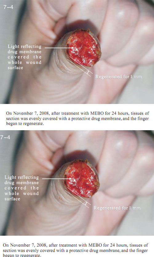 9170金沙集团_2 Regenerative restoration ofr severed fingers
