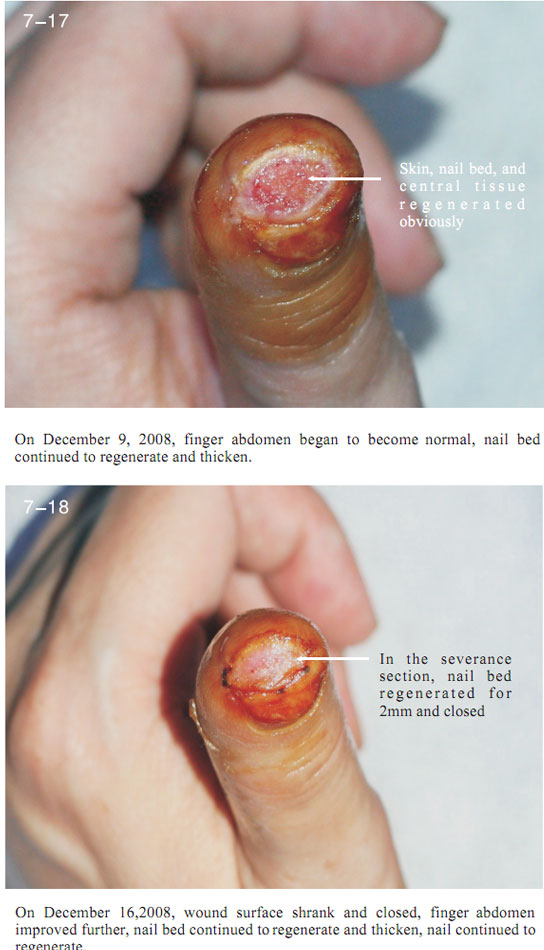 9170金沙集团_2 Regenerative restoration ofr severed fingers