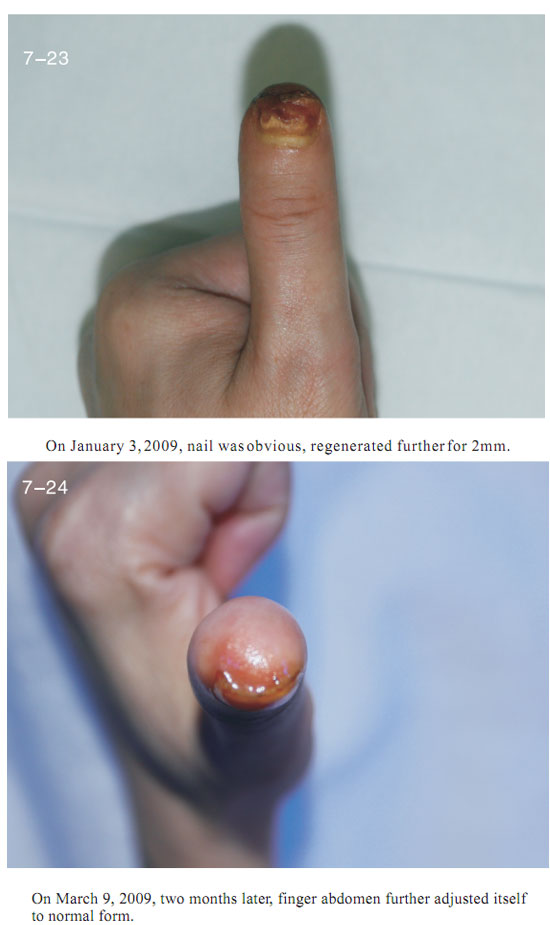 9170金沙集团_2 Regenerative restoration ofr severed fingers