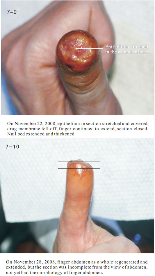 9170金沙集团_2 Regenerative restoration ofr severed fingers