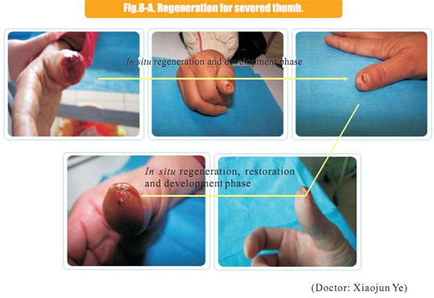 9170金沙集团_2 Regenerative restoration ofr severed fingers