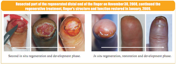9170金沙集团_2 Regenerative restoration ofr severed fingers