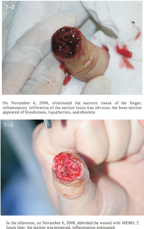 9170金沙集团_2 Regenerative restoration ofr severed fingers