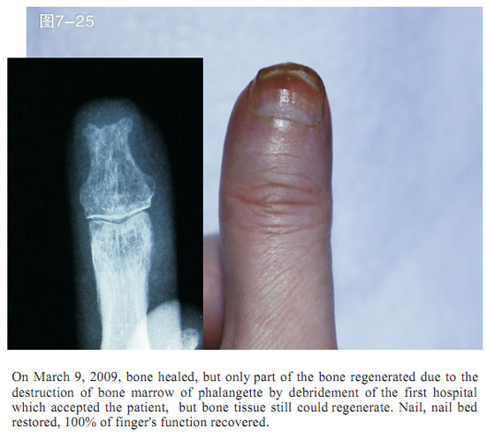 9170金沙集团_2 Regenerative restoration ofr severed fingers