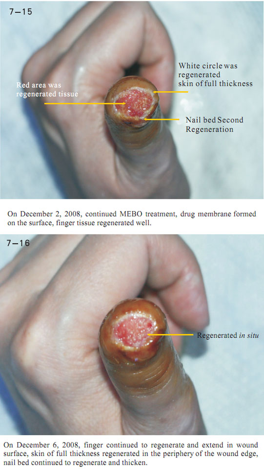 9170金沙集团_2 Regenerative restoration ofr severed fingers