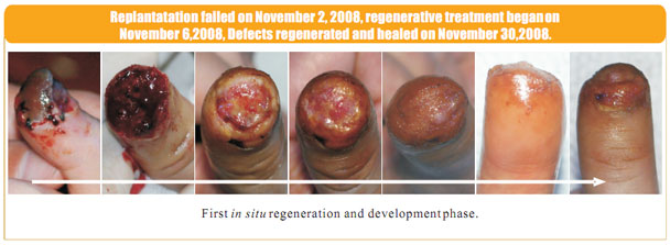 9170金沙集团_2 Regenerative restoration ofr severed fingers