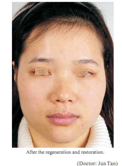 9170金沙集团_4  Regenerative restoration of skin scar tissues