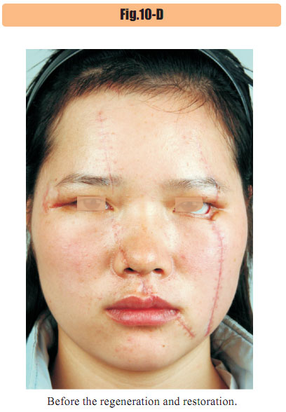 9170金沙集团_4  Regenerative restoration of skin scar tissues
