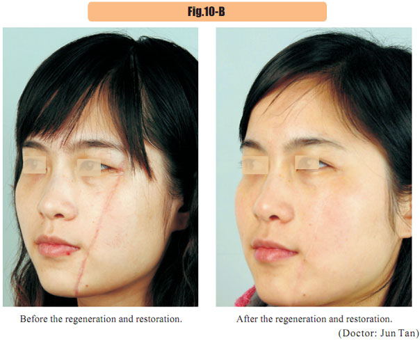 9170金沙集团_4  Regenerative restoration of skin scar tissues