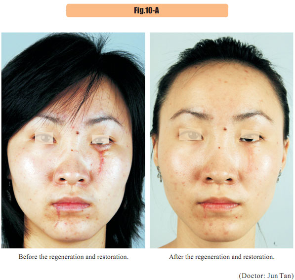 9170金沙集团_4  Regenerative restoration of skin scar tissues