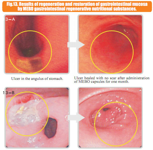 9170金沙集团_6  In situ regenerative restoration of gastrointestinal muco