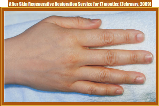 9170金沙集团_Part Two: Examples of in situ Skin Regenerative Restoration