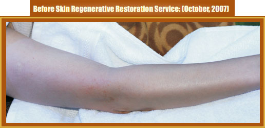 9170金沙集团_Part Two: Examples of in situ Skin Regenerative Restoration