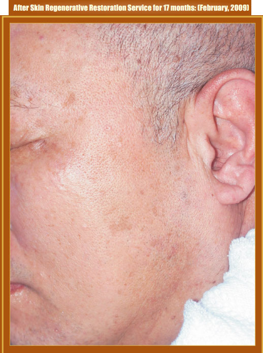 9170金沙集团_Part Two: Examples of in situ Skin Regenerative Restoration